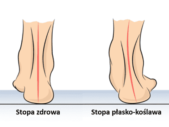 Czym jest stopa płasko-koślawa?