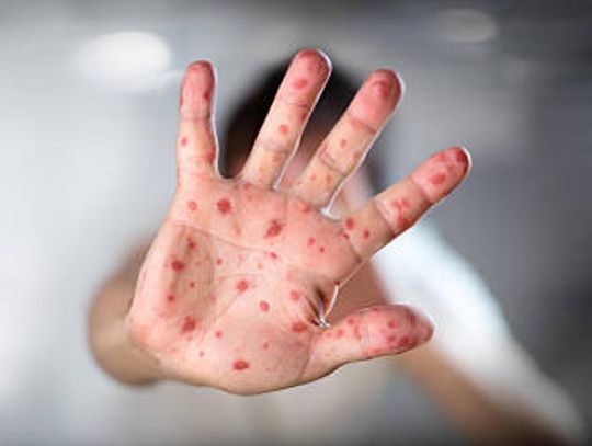 Rosnące ognisko odry na Podkarpaciu. Już 6 potwierdzonych przypadków, w tym u lekarza