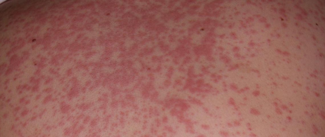 Uwaga na odrę na Podkarpaciu. Potwierdzone przypadki i apel sanepidu o szczepienia